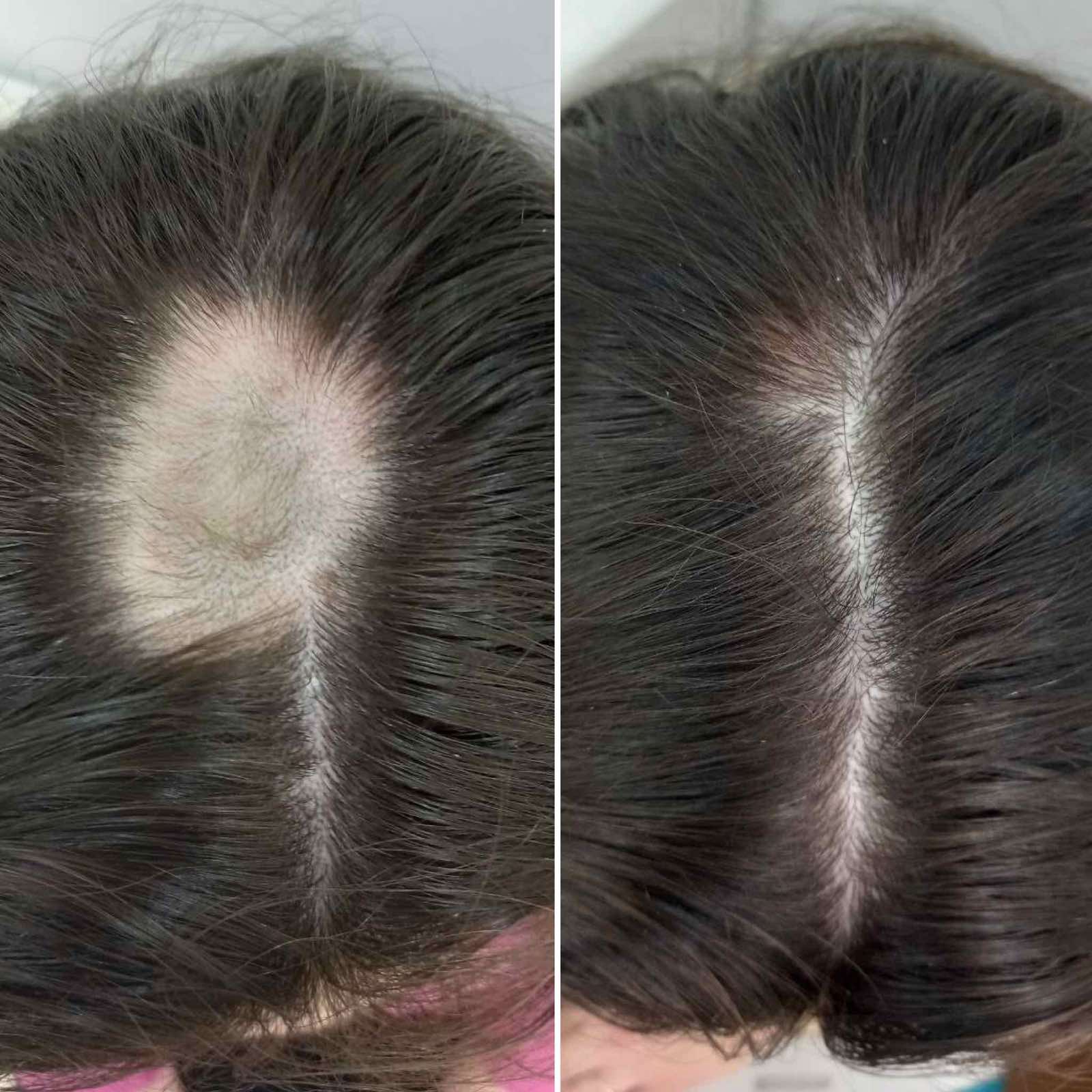 до-после лечение алопеции