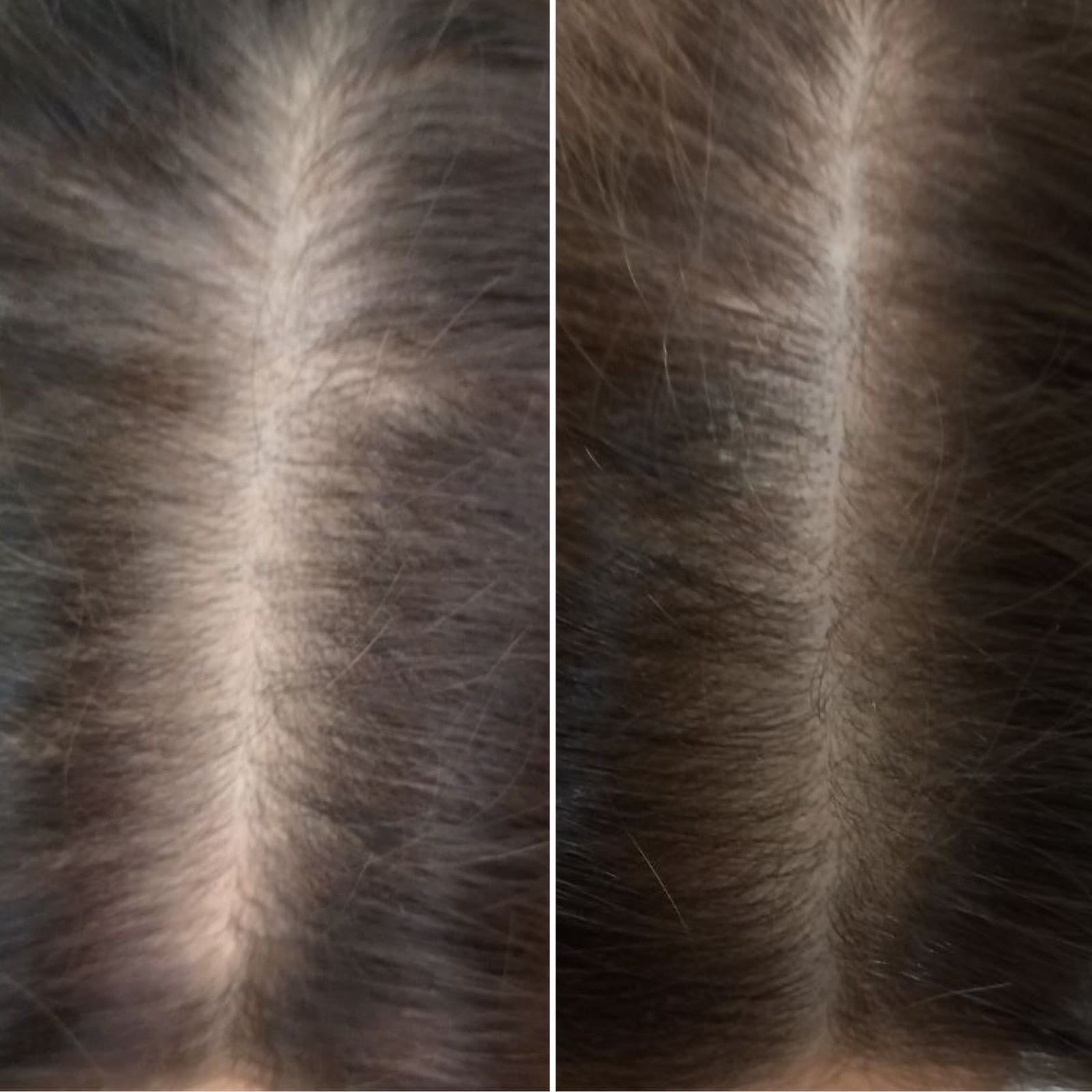 Мезотерапия волос до/после