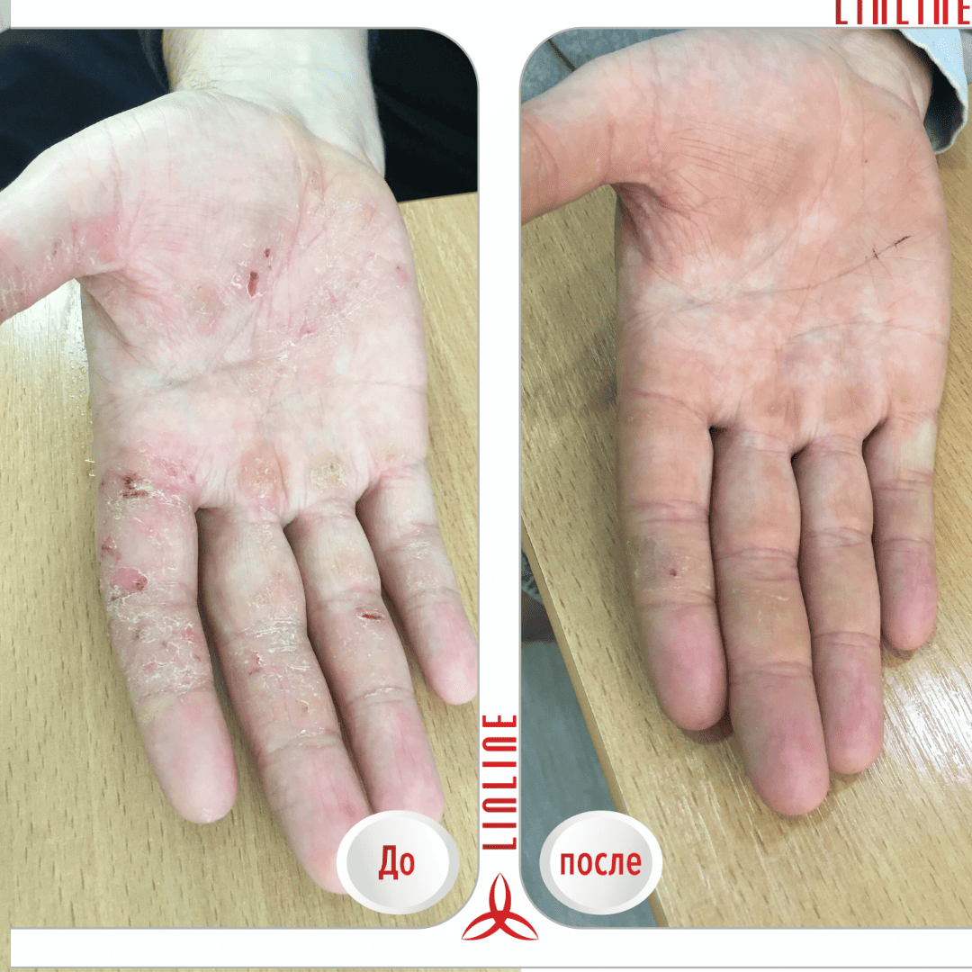 врач-дерматолог до-после