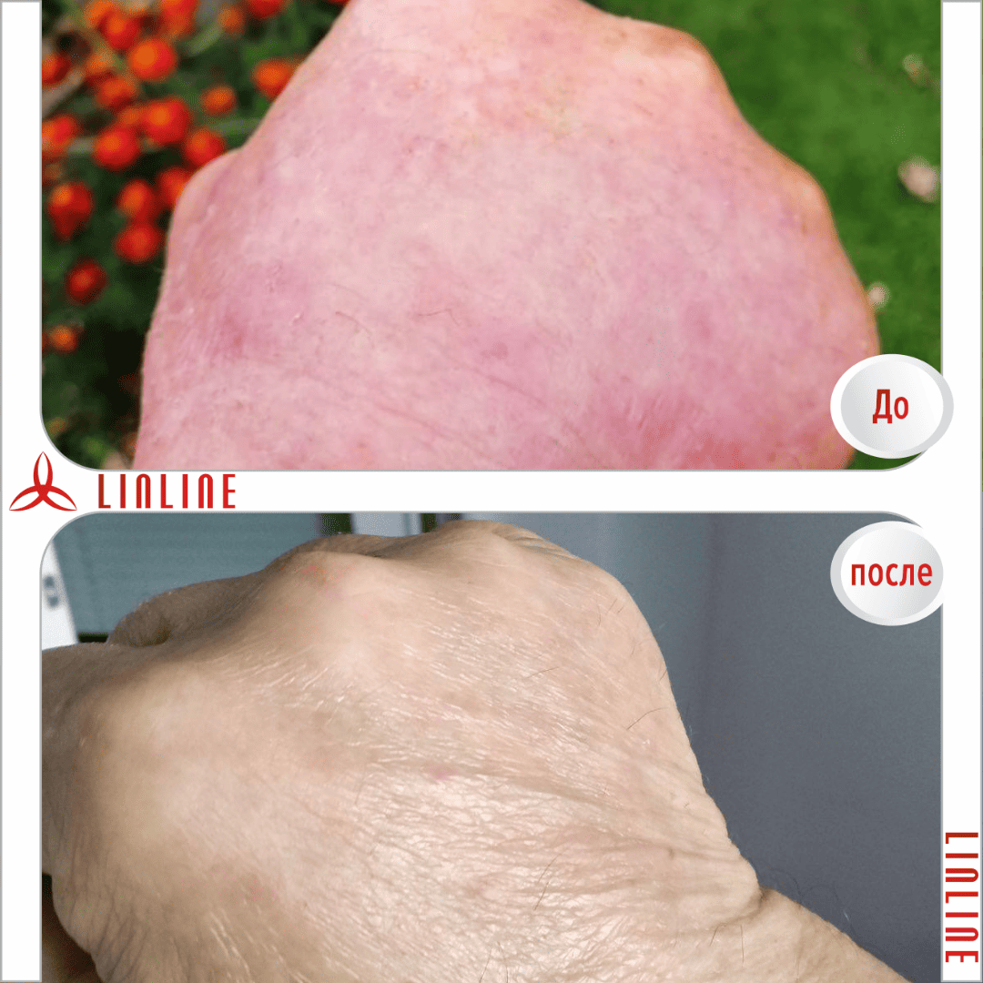 лечение кожных заболеваний в Минске до после