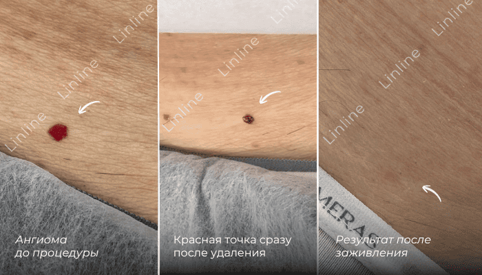Красная точка (ангиома) до лазерного удаления