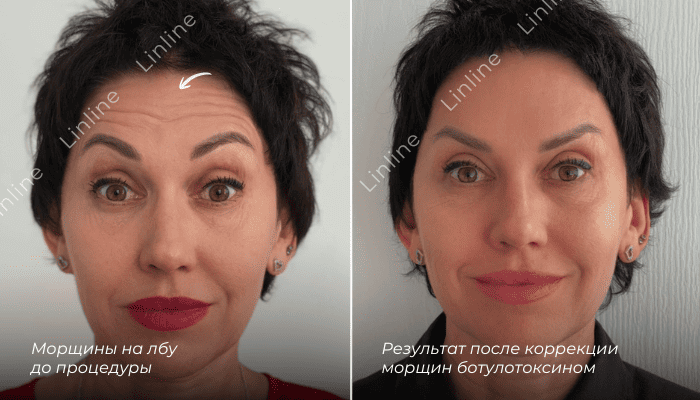 до/после ботулинотерапия