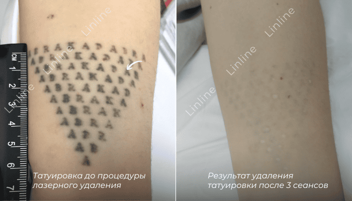 Удаление татуировки в Минске