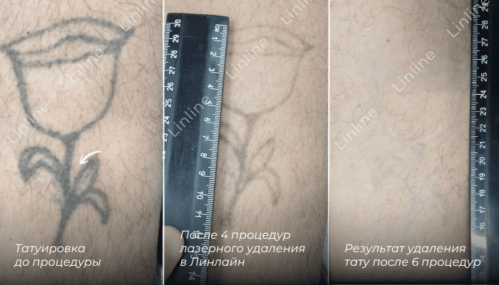 Лазерное удаление тату в Минске