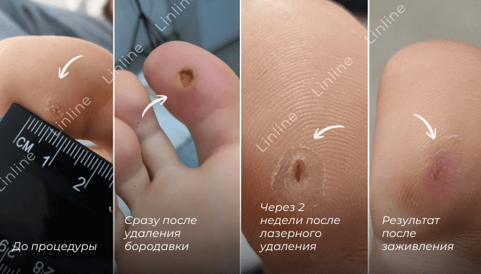 Процесс заживления бородавки после лазерного удаления