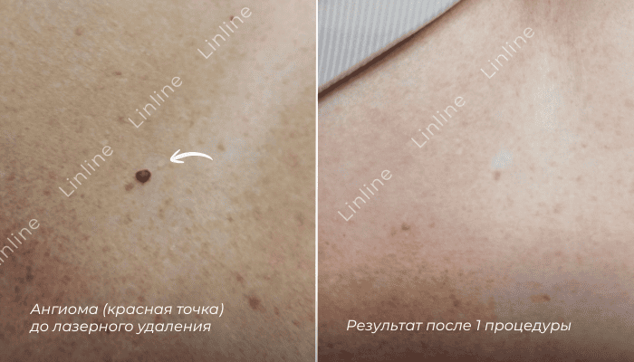 Ангиома результат до и после удаления