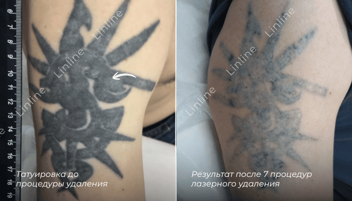 Удаление старой татуировки 