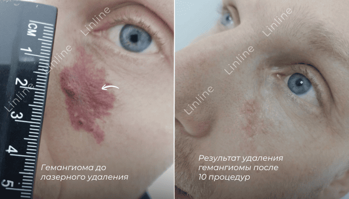 Лазерная коагуляция гемангиомы в клинике лазерной хирургии Линлайн