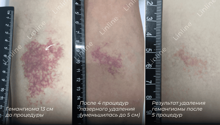 До и после удаления гемангиомы в клинике Линлайн