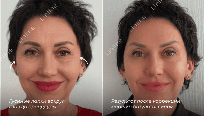 ботулинотерапия до/после Минск