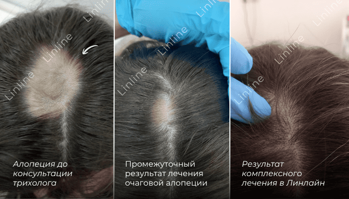 Лечение волос лазером в Минске после ковида