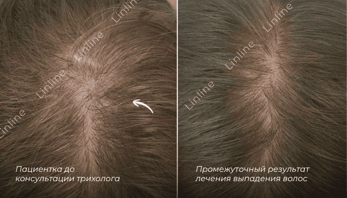 Лазерное лечение волос лазером в Минске до и после, результат