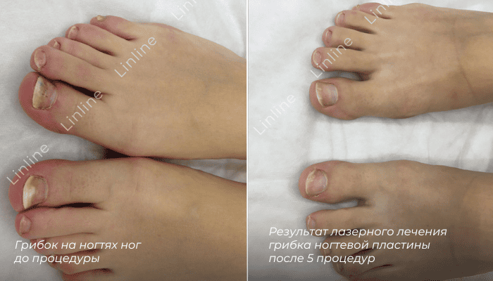 Грибок ногтевой пластины до/после