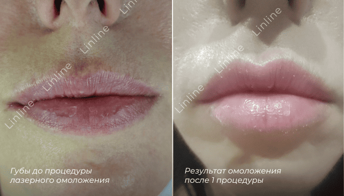 до/после лазерного омоложения губ