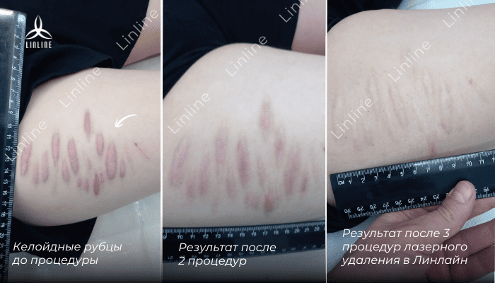 До и после удаления шрамов в Linline.