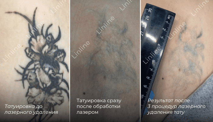 Лазерное удаление тату в Минске