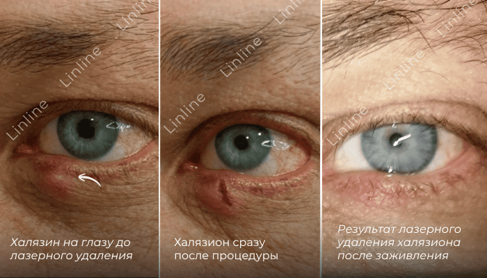 Лечение халязиона лазером в Минске