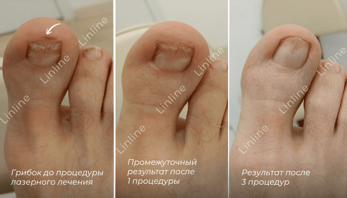 До/после лечения грибка ногтей в Линлайн