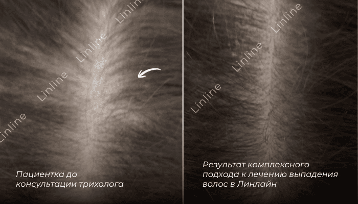 Лечение выпадения волос лазером в Минске до и после