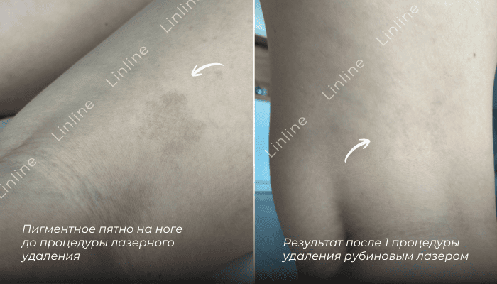 Пигментное пятно на ноге