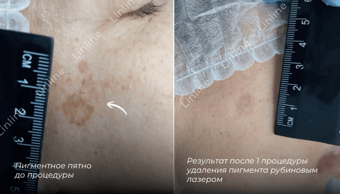 Пигментное пятно на лице удаление лазером