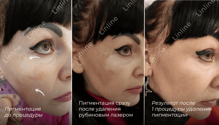 Пигментные пятна на скулах