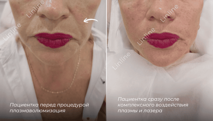 Плазмаволюмизация плюс лазерный лифтинг до/после