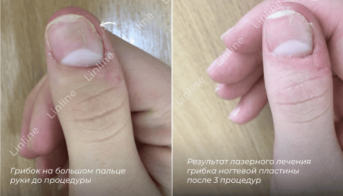 Лечение грибка ногтей на большом пальце руки до/после