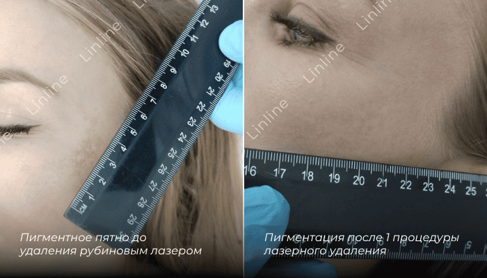 Удаление пигментации после 1 процедуры
