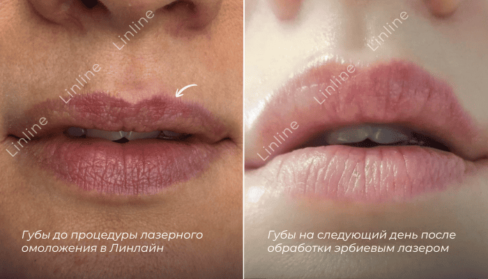 Лазерное омоложение губ в Минск фото до-после