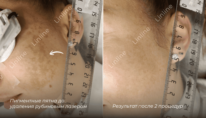 Пигментные пятна на лице 