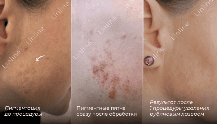 Удаление пигментации на лице до и после
