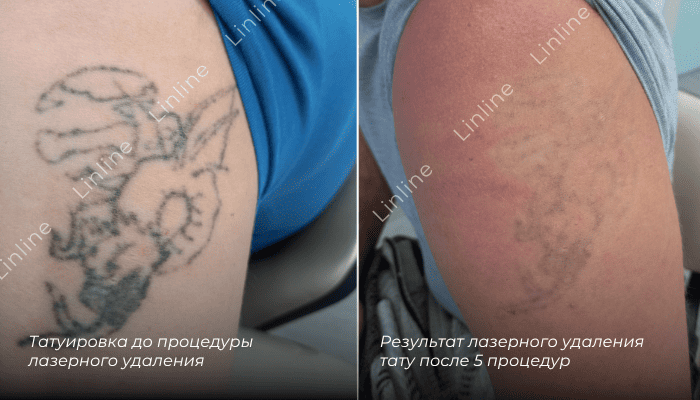 Удаление старой татуировки лазером в Минске