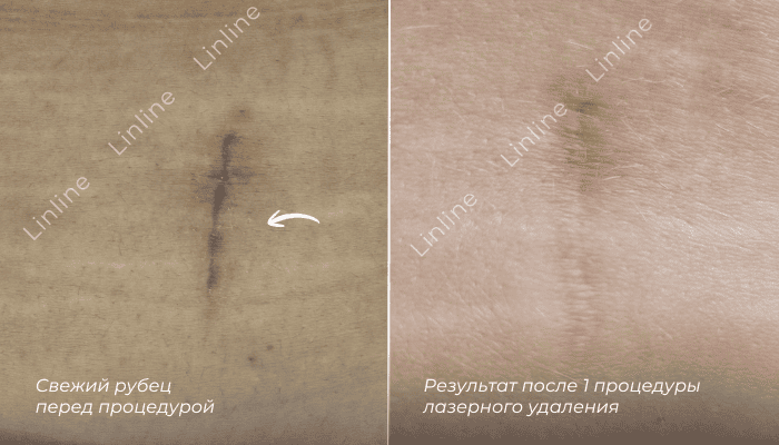Результат удаления шрама до и после