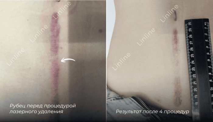 Рубец на животе фото до и после процедур