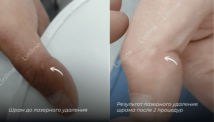 Удаление шрама на пальце до и после