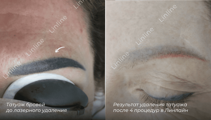 Удаление перманентного макияжа фото до и после