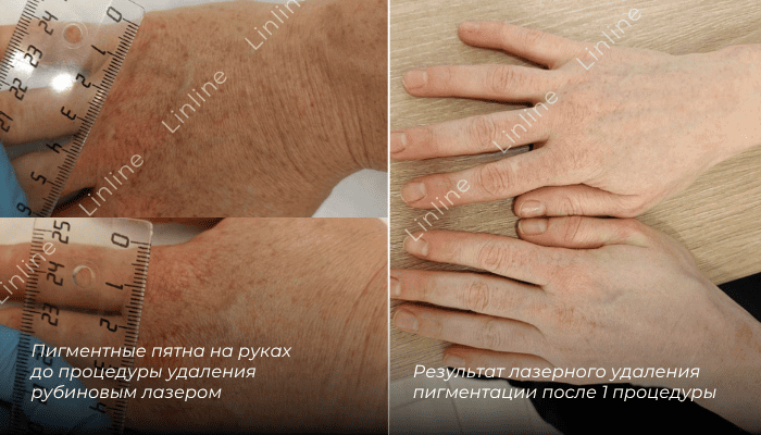 Пигментация на руках