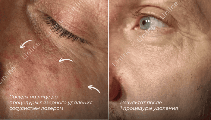 Лазерное удаление сосудов. сосудистых «звездочек», ангиом, гемангиом, «винных» пятен в Минске
