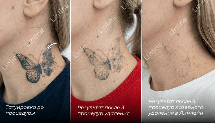 Результат удаления тату бабочки на шее