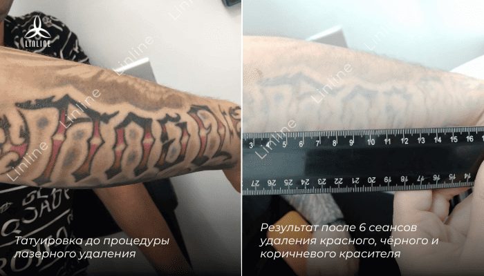 До и после удаления татуировки в клинике Минска