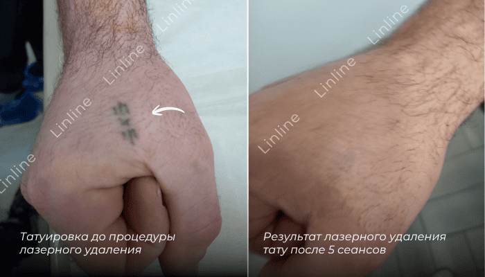 Лазерное удаление татуировки на руке в Минске Линлайн