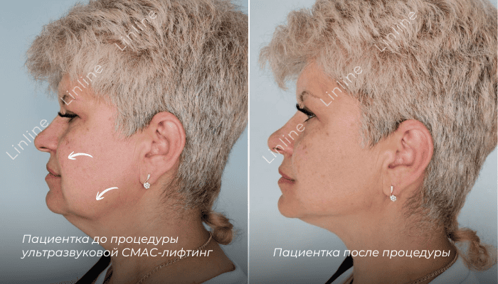 результат до/после СМАС-лифтинг